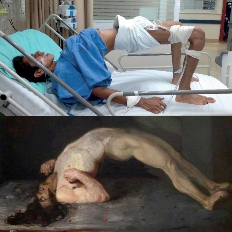 Con Il Tetano La Ferita Si Cicatrizza
