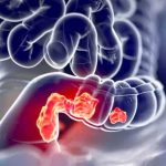 Cancro al colon-retto: diagnosi precoce grazie al microbioma intestinale