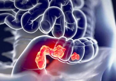 Cancro al colon-retto: diagnosi precoce grazie al microbioma intestinale