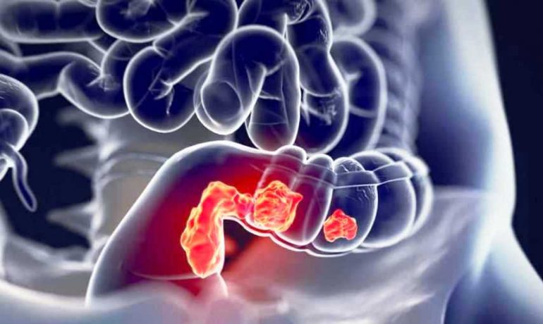 Cancro al colon-retto: diagnosi precoce grazie al microbioma intestinale