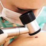 Carcinoma cutaneo a cellule squamose, via libera al commercio di cemiplimab