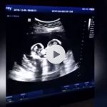 Gemelline giocano nell’utero della mamma: l’ecografia diventa virale