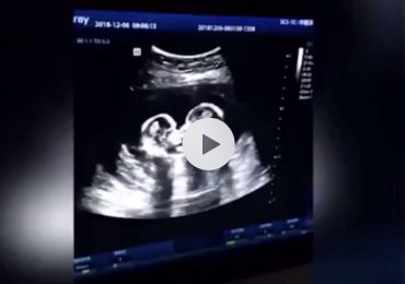 Gemelline giocano nell’utero della mamma: l’ecografia diventa virale