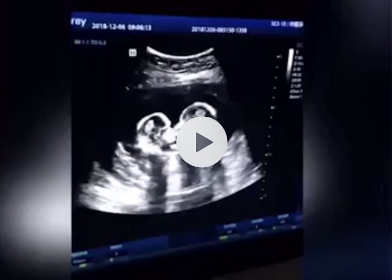 Gemelline giocano nell’utero della mamma: l’ecografia diventa virale