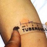 Maestra con la tubercolosi: epidemia a scuola