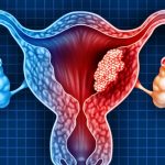 Tumore ovarico: nuove terapie e importanza della prevenzione
