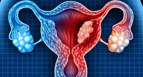 Tumore ovarico: nuove terapie e importanza della prevenzione