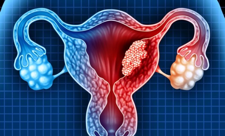 Tumore ovarico: nuove terapie e importanza della prevenzione