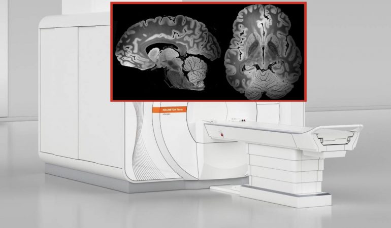 L’immagine più definita di sempre del cervello umano grazie ad una risonanza magnetica durata 100 ore