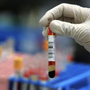 Institute for Biology of Aging:“La presenza di 14 biomarcatori nel sangue preannuncia la morte entro 10 anni”