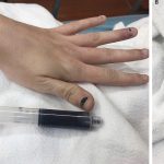 Quando sangue e cute assumono uno strano colore: un caso di metaemoglobinemia acquisita