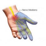Sindrome del tunnel carpale: sintomi e cura
