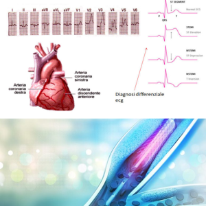 STEMI e malattia multivasale: focus su angioplastica coronarica