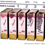 Livelli di Clark nella stadiazione Melanoma