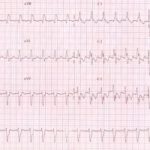 Nuove linee guida ESC 2019 (Società europea di cardiologia 2019)per  trattamento tachicardia sopraventricolare