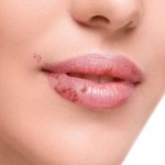 Herpes simplex: richiamo volontario per un farmaco antivirale
