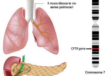 Nuovo trattamento fibrosi cistica: bene triplice terapia elexacaftor/tezacaftor/ivacaftor