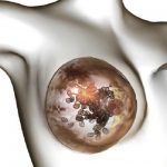 Tumore al seno, individuato l’enzima che facilita la diffusione delle metastasi