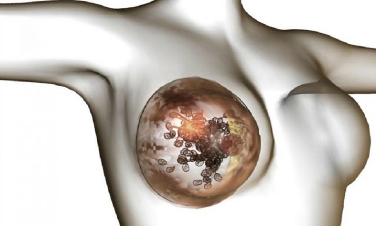 Tumore al seno, individuato l’enzima che facilita la diffusione delle metastasi
