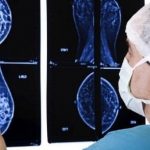 Tumore al seno: l’efficacia delle nuove terapie