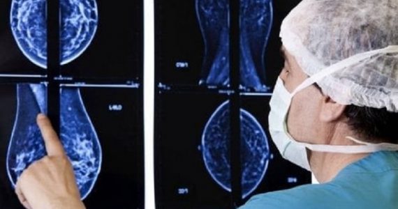 Tumore al seno: l’efficacia delle nuove terapie