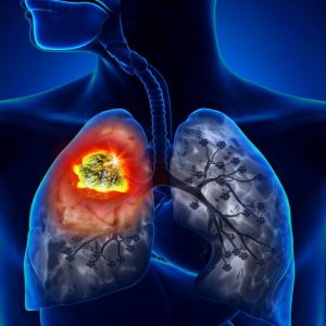Tumore polmonare e mutazioni genetiche: come cambia la vita dei pazienti