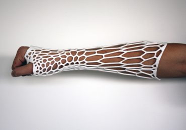 Cortex, l’esoscheletro 3D su misura che sostituirà il tradizionale apparecchio gessato