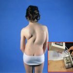 Osp. Infantile Regina Margherita: rara forma di scoliosi trattata con barre di accrescimento magnetiche