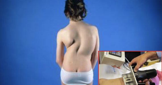 Osp. Infantile Regina Margherita: rara forma di scoliosi trattata con barre di accrescimento magnetiche