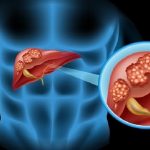 Colangiocarcinoma: gli “inganni” di un tumore sempre più diffuso