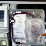 Donazione dopo morte cardiaca: organo trapiantato molte ore dopo la morte clinica grazie alla Perfusione Regionale Normotermica
