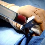 Donazione midollo: come si svolge la procedura