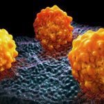 Linfoma non-Hodgkin resistente: nuove speranze per chi non risponde alle terapie