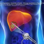 Padova, risultati incoraggianti per la cura dei tumori epatici dalla termoablazione con microonde