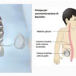Paralisi cerebrale infantile: l’uso della pompa al baclofene per ridurre la spasticità