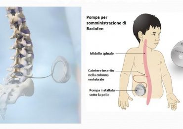 Paralisi cerebrale infantile: l’uso della pompa al baclofene per ridurre la spasticità