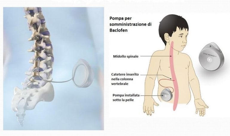 Paralisi cerebrale infantile: l’uso della pompa al baclofene per ridurre la spasticità