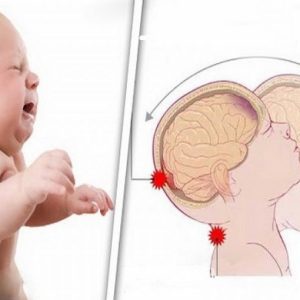 Prevenzione della sindrome del bambino scosso (Shaken Baby Syndrome)