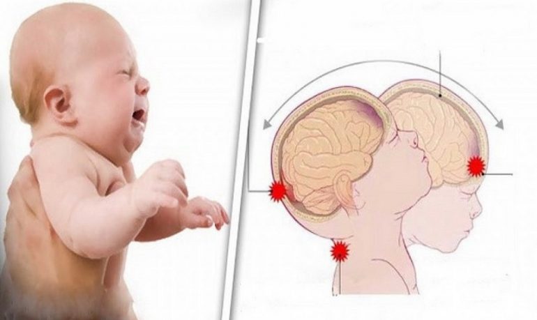 Prevenzione della sindrome del bambino scosso (Shaken Baby Syndrome)