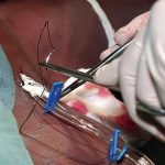 Re-audit clinico sull'implementazione delle evidenze per la prevenzione di infezioni correlate a catetere venoso centrale
