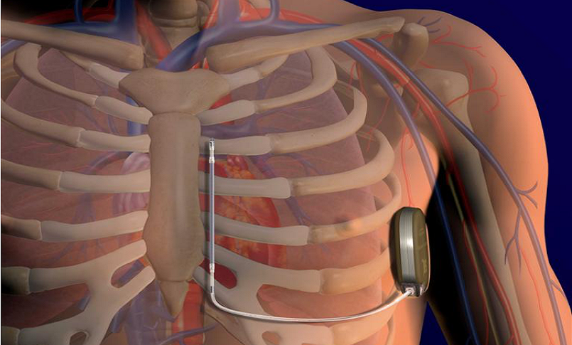 L'assistenza infermieristica pre-impianto S-ICD