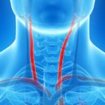 Stenosi carotidee, la rivascolarizzazione può far regredire i deficit cognitivi?