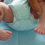 Trattamento del piede torto congenito: il metodo Ponseti