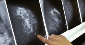 Tumore al seno, perdere peso riduce il rischio per le over 50