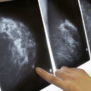 Tumore al seno, perdere peso riduce il rischio per le over 50