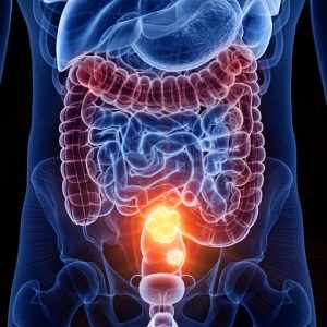 Colon-retto: dal microbiota intestinale un freno allo sviluppo del tumore.