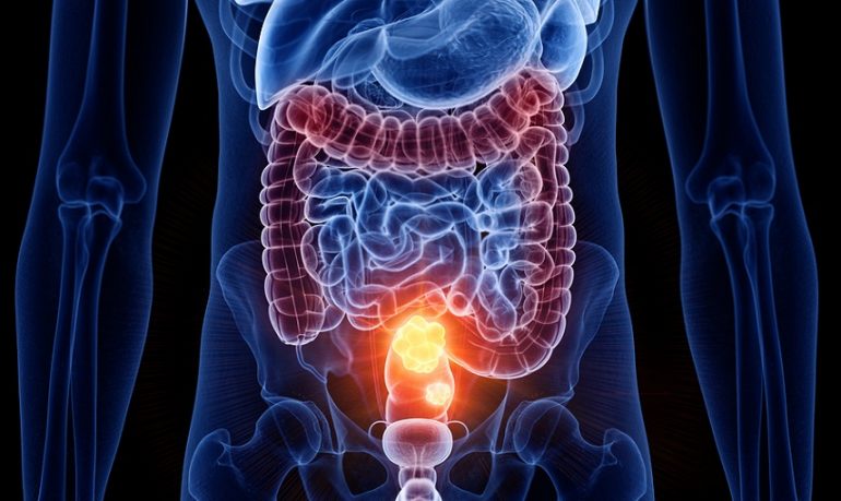 Colon-retto: dal microbiota intestinale un freno allo sviluppo del tumore.