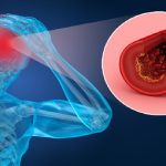 Ictus e livelli di colesterolo: valori a confronto