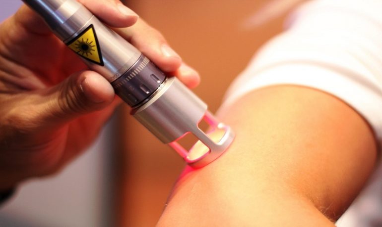 Il dye laser per il trattamento delle anomalie vascolari pediatriche
