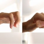 Neurotizzazione per il recupero delle mani: 14 pazienti trattati in Emilia Romagna